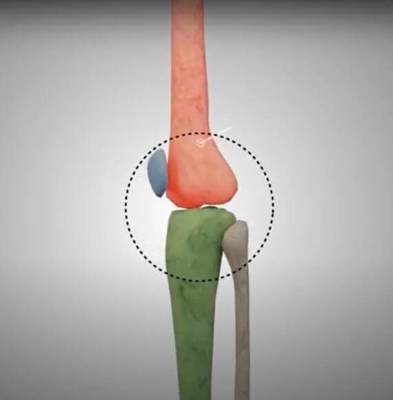 Implantation Image
