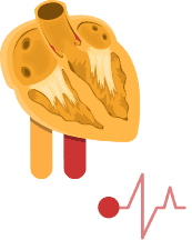 Abnormal heart sound