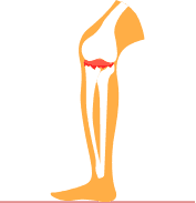 Bone spurs